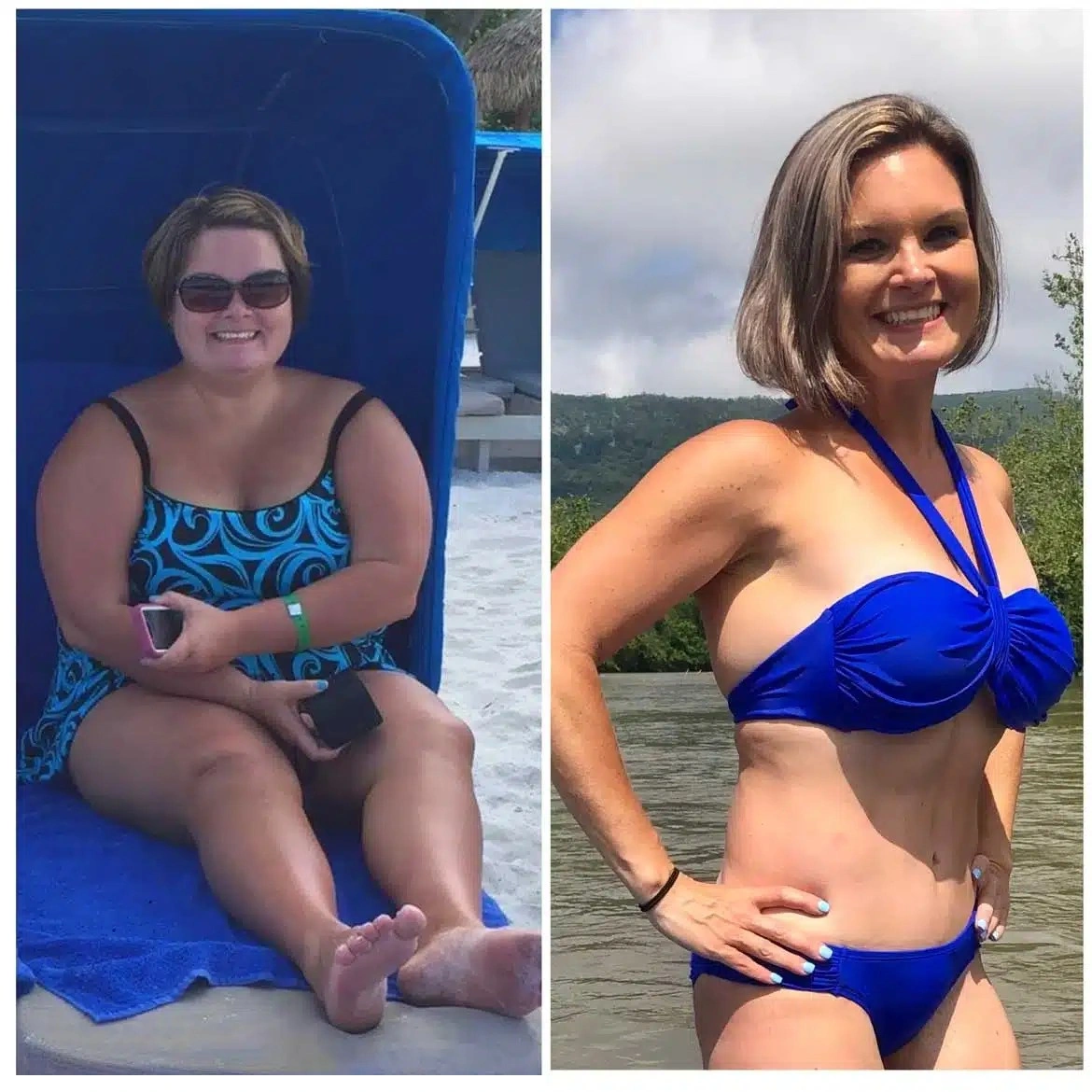 Weight loss surgery patient outcome